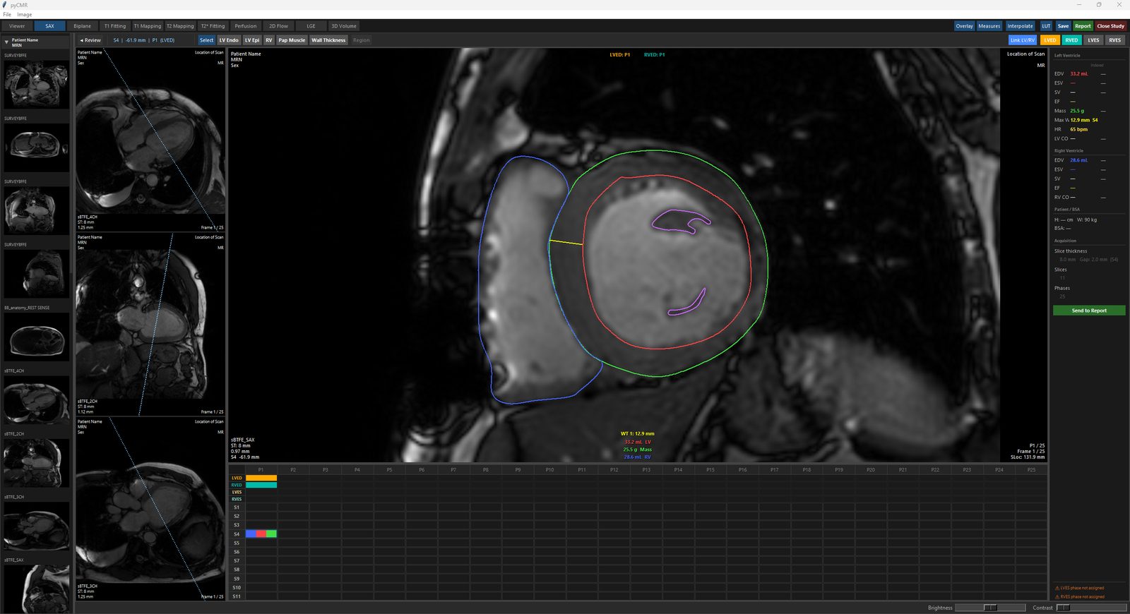 SAX Quantify with a full short-axis stack, long-axis reference views, and live volumetry.