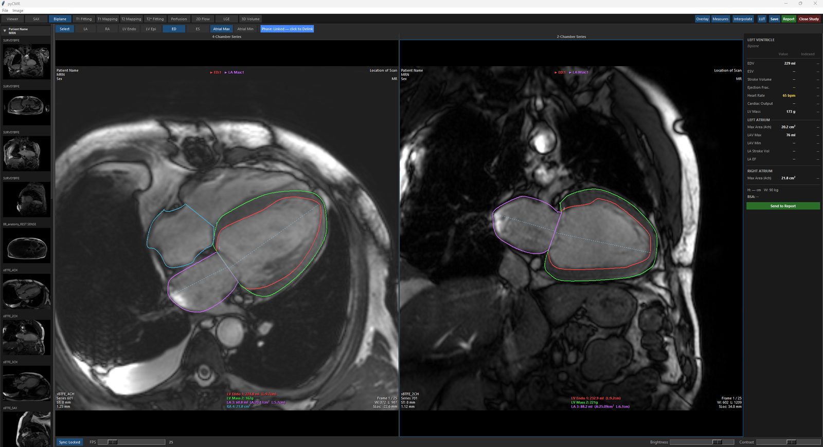 LV Endo/Epi traced on both the 4-chamber and 2-chamber panels in Biplane.