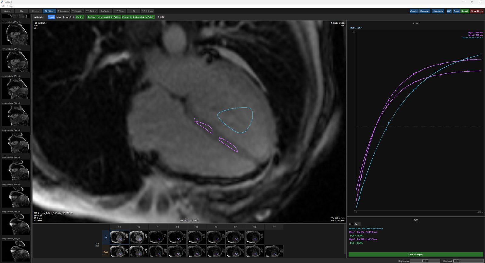 T1 Fitting Analysis: Myo and Blood Pool ROIs, fit graph, and ECV panel.