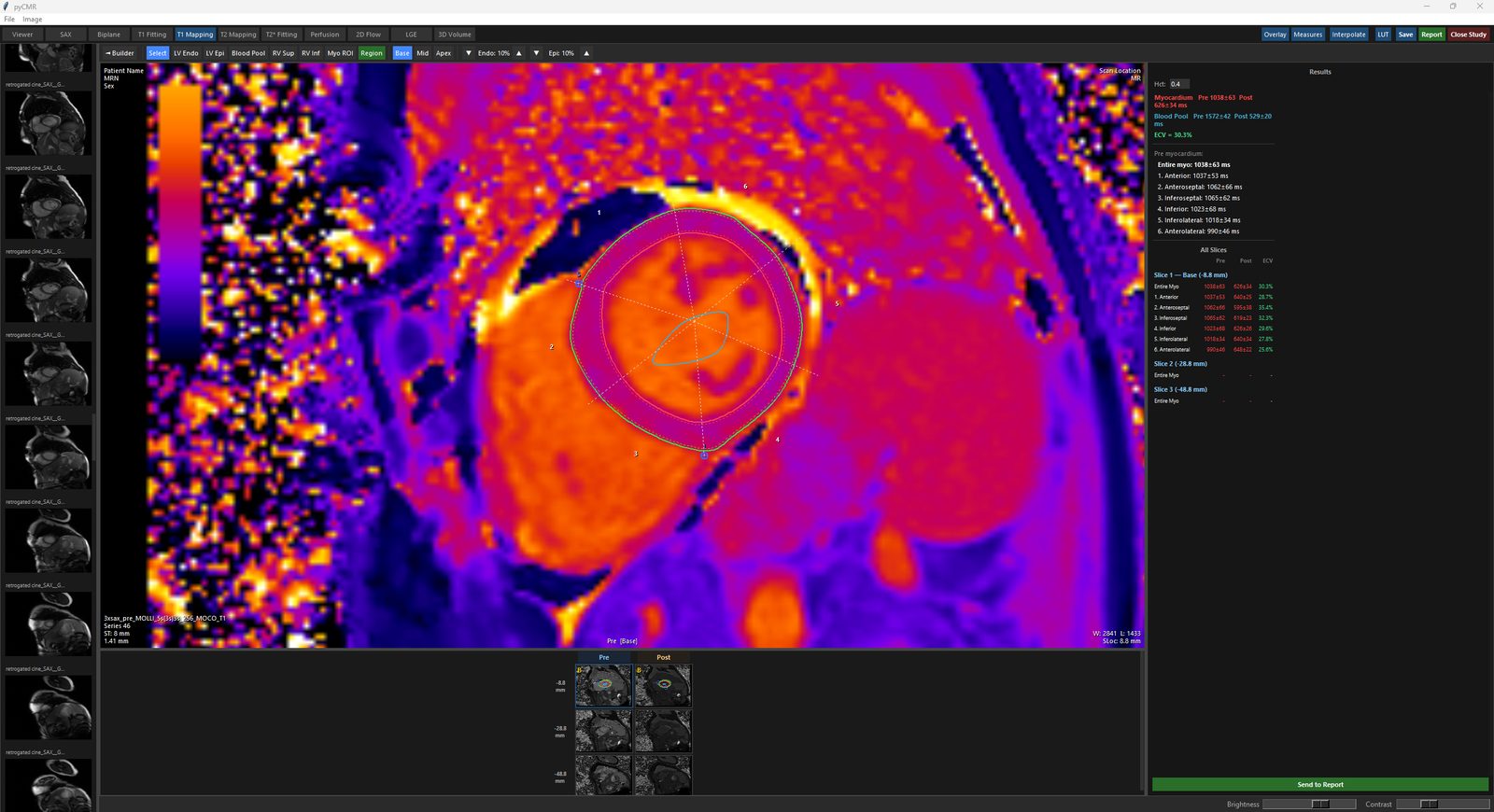 T1 Mapping Analysis: Endo/Epi and RV insertion points on a colour T1 map, with AHA segments numbered.
