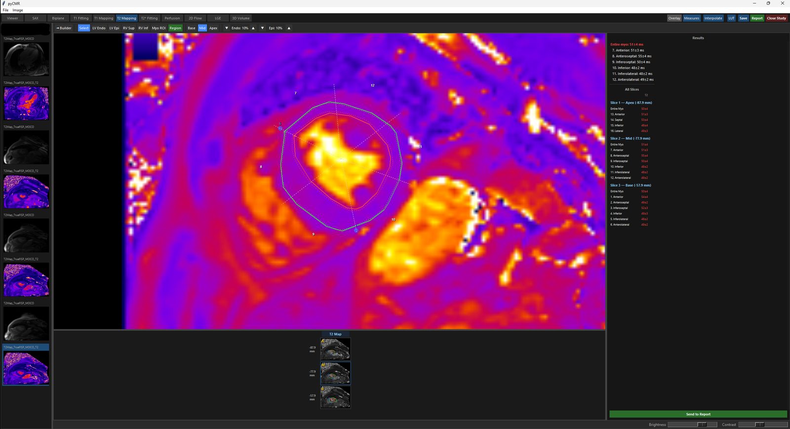 T2 Mapping Analysis: Endo/Epi and RV insertion points drawn, segments numbered.