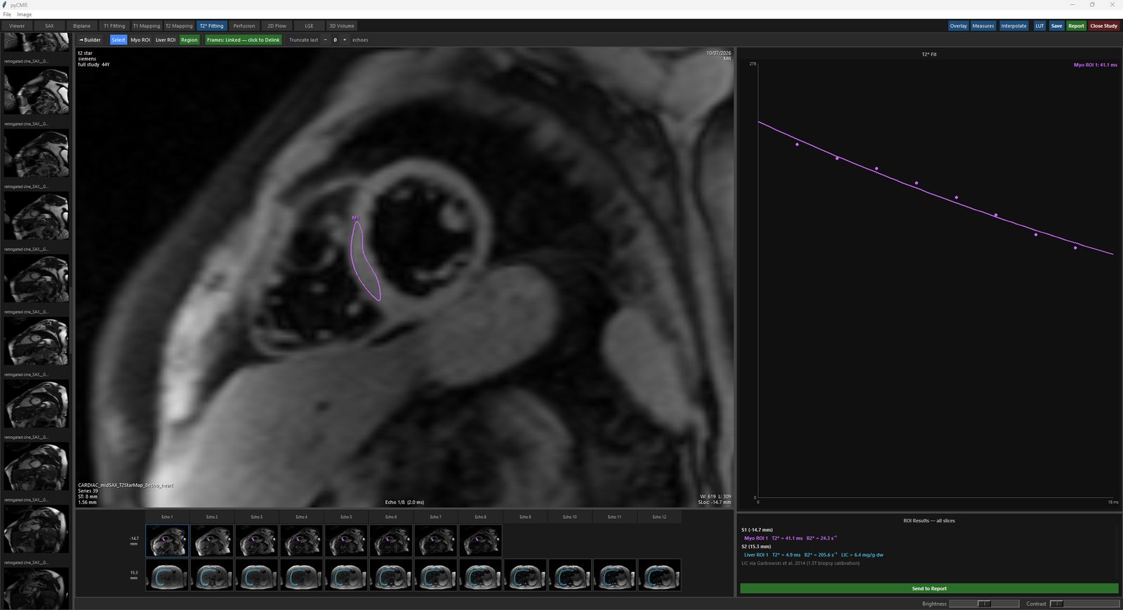 T2* Fitting Analysis: Myo ROI traced on a cardiac echo stack, with the T2* fit graph and results panel.