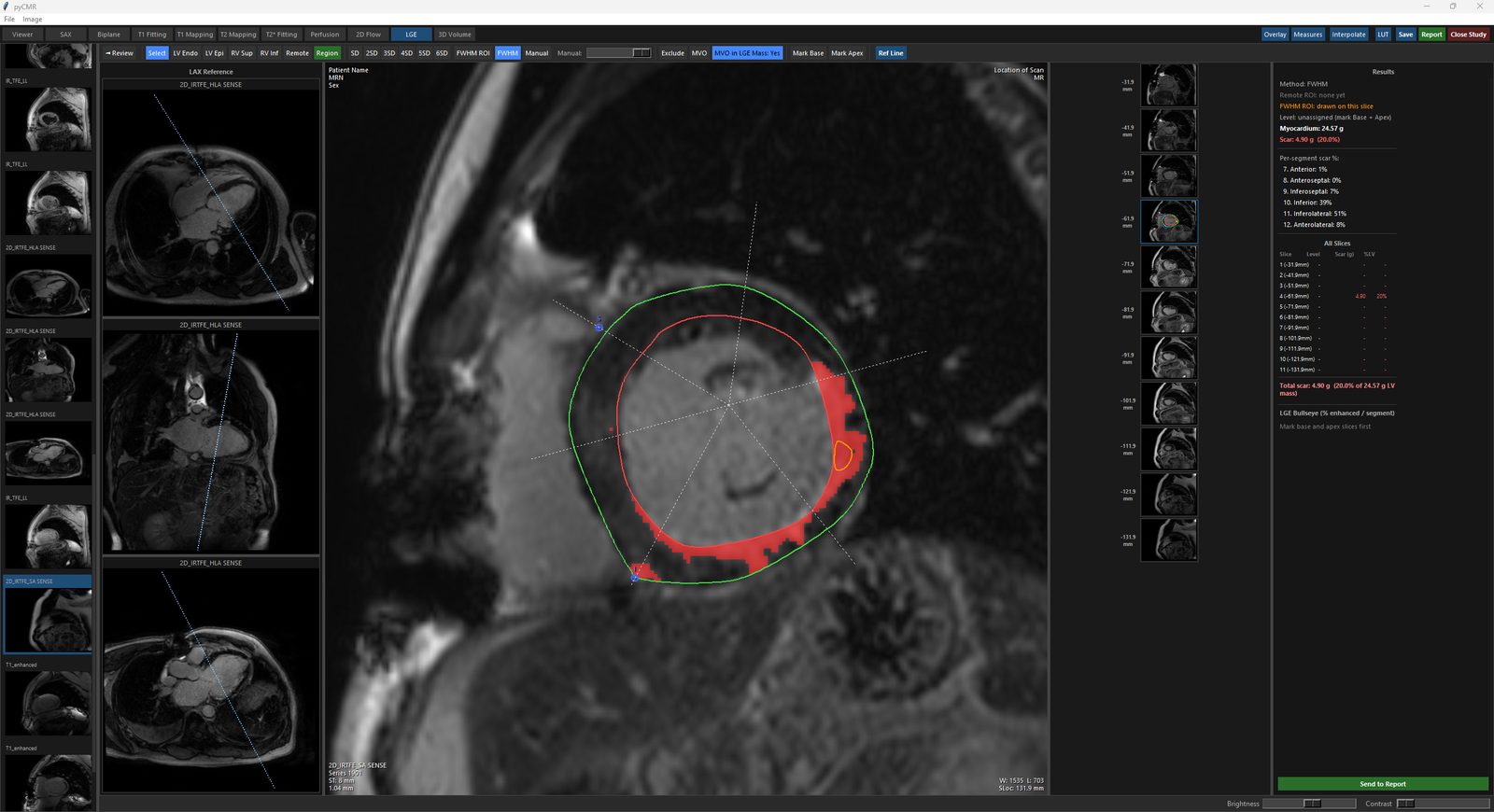 LGE Quantify: LV Endo/Epi and RV insertion points drawn, scar region highlighted, segments numbered.