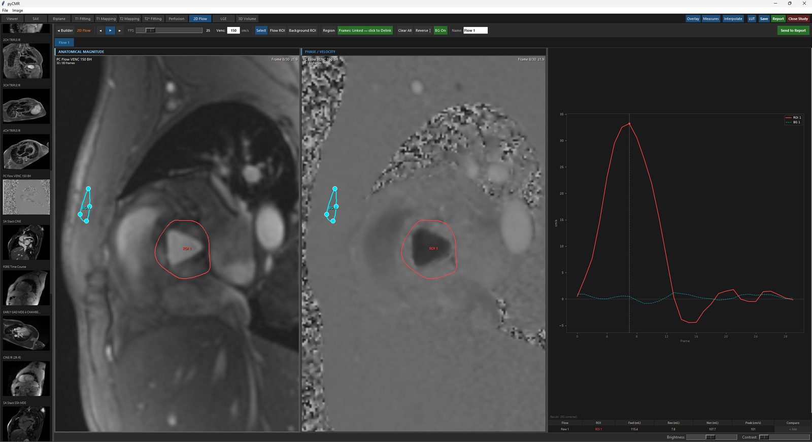 2D Flow Analysis: Flow ROI and Background ROI drawn on both the Mag and Phase/Velocity panels, with the flow-velocity curve graph and results row.