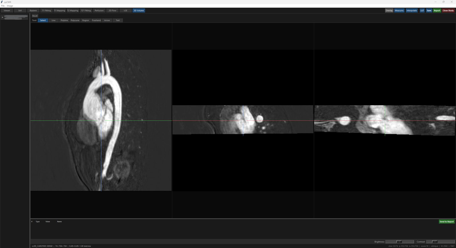 3D Volume's three linked MPR panels, each panel's crosshair showing where the other two currently cut through it.