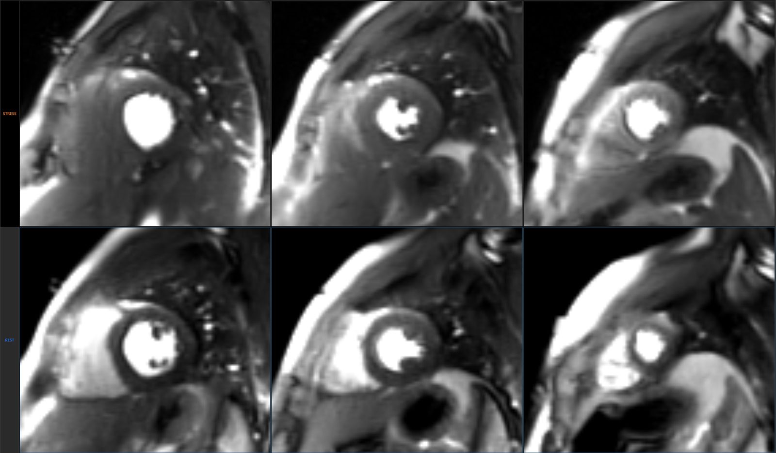 Perfusion Review: Stress (top row) and Rest (bottom row) slices side by side, one column per short-axis level.