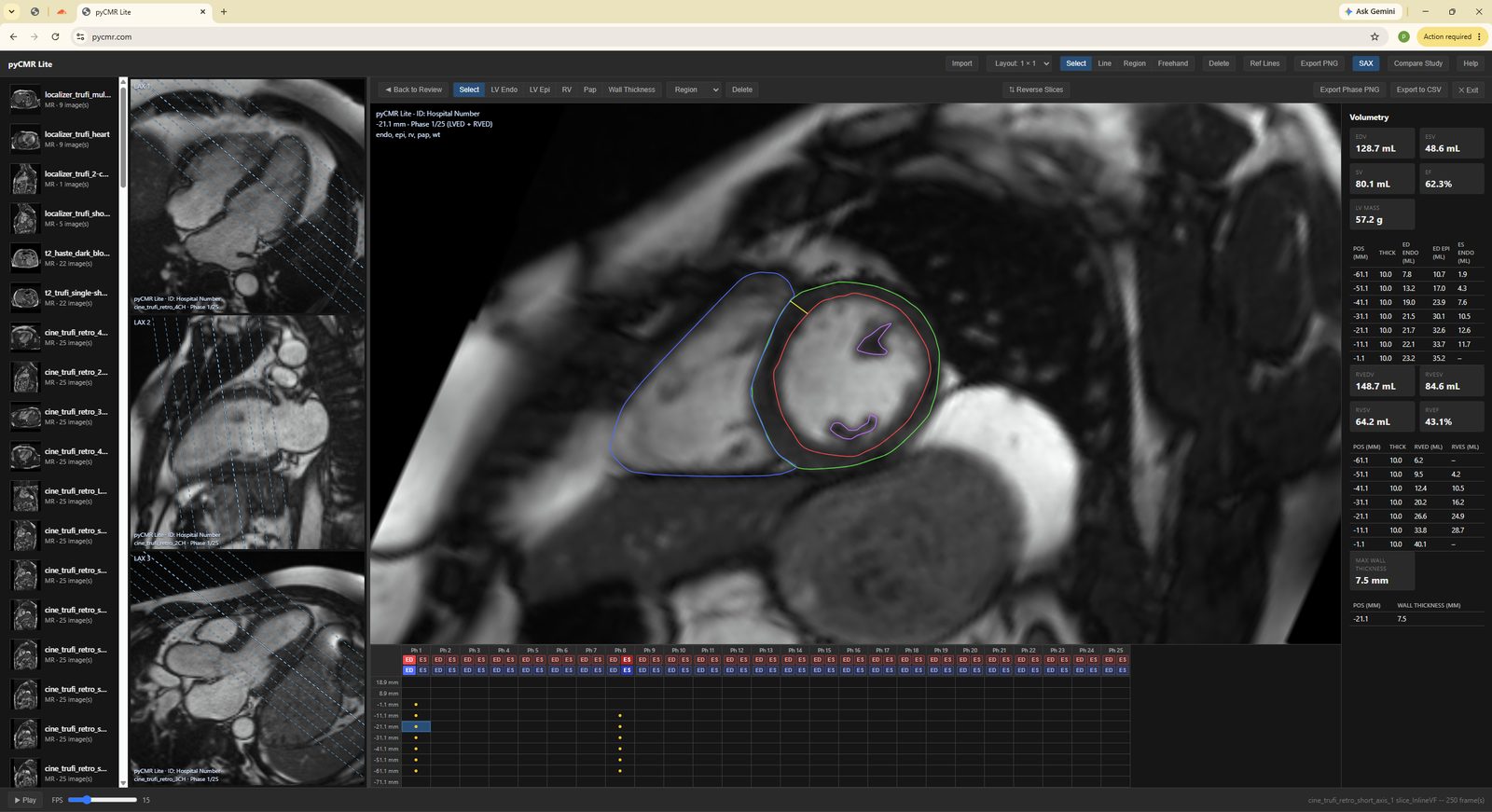 FreeCMR Lite's SAX Quantify screen: LV Endo/Epi/RV contours drawn on a short-axis slice, LAX reference panels with dashed cut-lines on the left, and live EDV/ESV/EF/mass volumetry on the right.